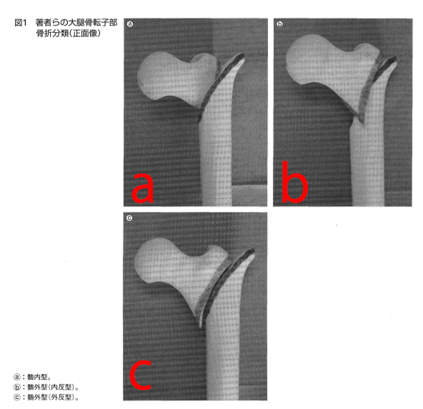 転子部骨折の内・外側骨片の分類と整復のポイント