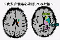 皮質脊髄路を脳画像で確認してみよう！