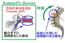 椎体骨折のKummell’s diseaseとVacuum cleft