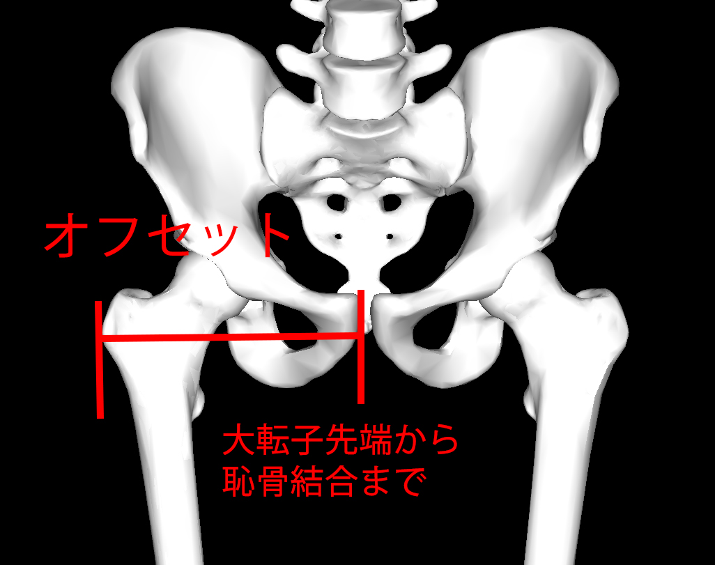 股関節のオフセットとは？外転筋力と伸張性が重要