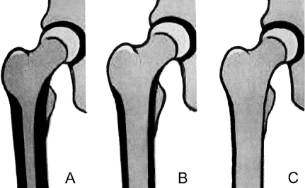 【Dorr（ドール）の分類】大腿骨の髄腔の個人差について