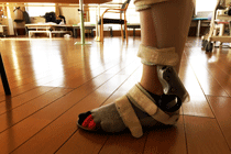 片麻痺の短下肢装具「ゲイトソリューション」を病院に借りてみた。