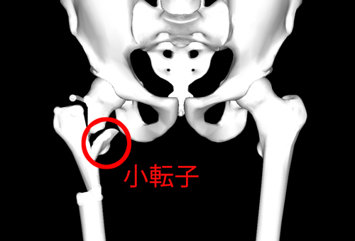 なぜ大腿骨頚部骨折・転子部骨折で小転子は整復しないの？