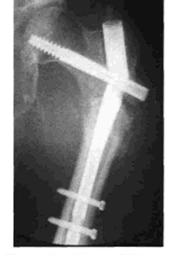 大腿骨転子部骨折の逆斜骨折ってどんな骨折？